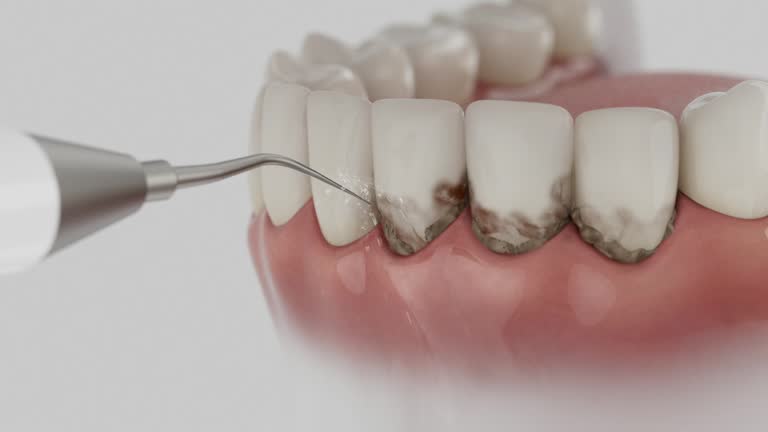 Trusted Wisdom Tooth Removal service in Whippany, NJ - Dentist Open Now